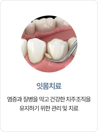 연세아크로치과 잇몸치료